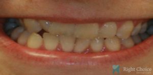 Invisaling-17 Before