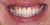 Implant-01 After