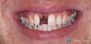 Implant-01 Before