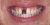 Implant-01 Before