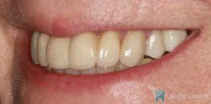Implant-02 After