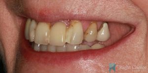 Implant-02 Before