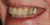 Implant-02 Before