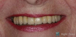 Implant-03 After