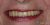 Implant-03 After