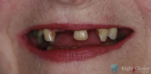 Implant-03 Before
