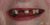 Implant-03 Before