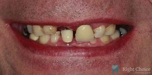 Implant-04 Before