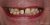 Implant-04 Before