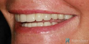 Implant-05 After