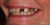 Implant-05 Before