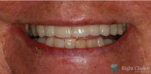 Implant-06 After