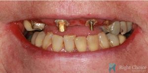 Implant-06 Before