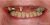 Implant-06 Before