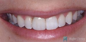 Implant-07 After