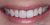 Implant-07 After