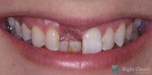 Implant-07 Before