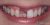 Implant-07 Before