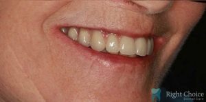 Implant-08 After