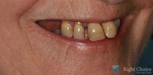 Implant-08 Before