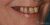 Implant-08 Before