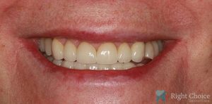 Implant-09 After