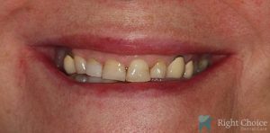 Implant-09 Before