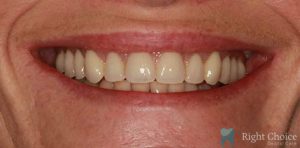 Implant-10 After