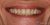 Implant-10 After