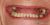 Implant-10 Before