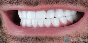 Implant-12 After