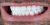 Implant-12 After