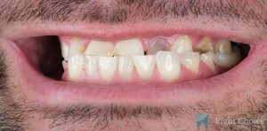 Implant-12 Before