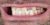 Implant-12 Before