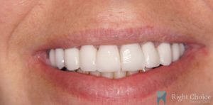 Implant-13 After