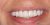 Implant-13 After