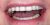 Implant-14 After