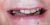 Implant-14 Before