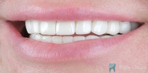 Veneer-01 After