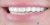 Veneer-01 After