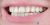 Veneer-01 Before