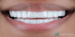 Veneer-01 After