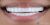 Veneer-01 After
