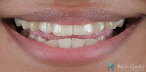 Veneer-02 Before