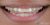 Veneer-02 Before