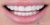 Veneer-03 After
