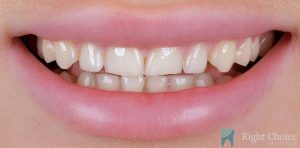 Veneer-03 Before