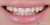 Veneer-03 Before