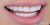 Veneer-05 After