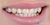 Veneer-05 Before